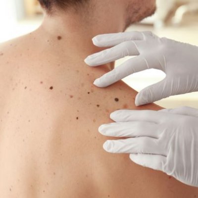 Gloved hands are on a person's bare back with fair skin, inspecting moles.